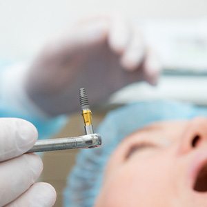 Closeup of dental implant about to be surgically placed in patient’s jaw