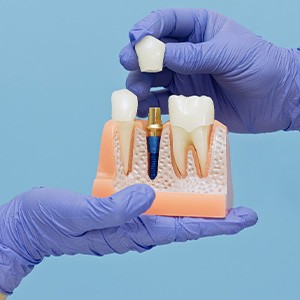 Blue-gloved hands holding large model dental implant