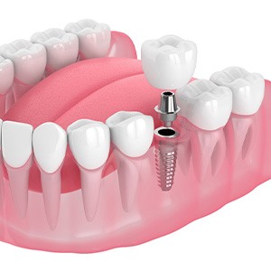 Illustration of a single dental implant