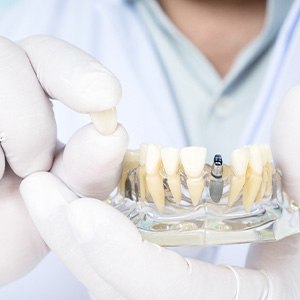White-gloved hands holding dental crown and model dental implant