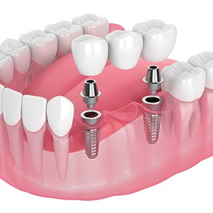 Illustration of an implant bridge