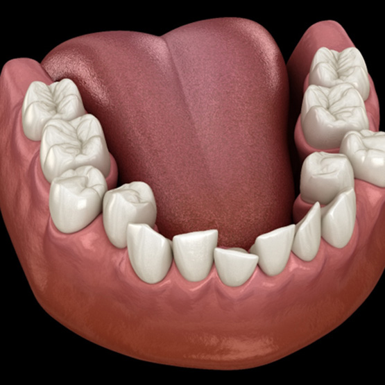 Digital image of crooked teeth that need orthodontics